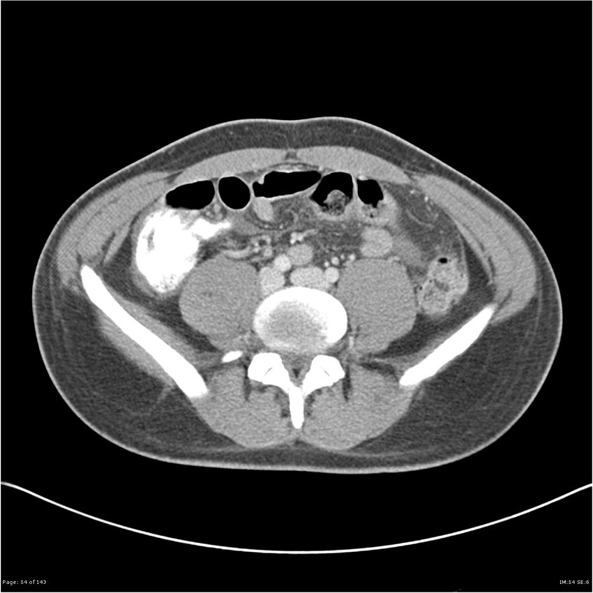 Acute appendicitis (Radiopaedia 25364-25615 B 44).jpg