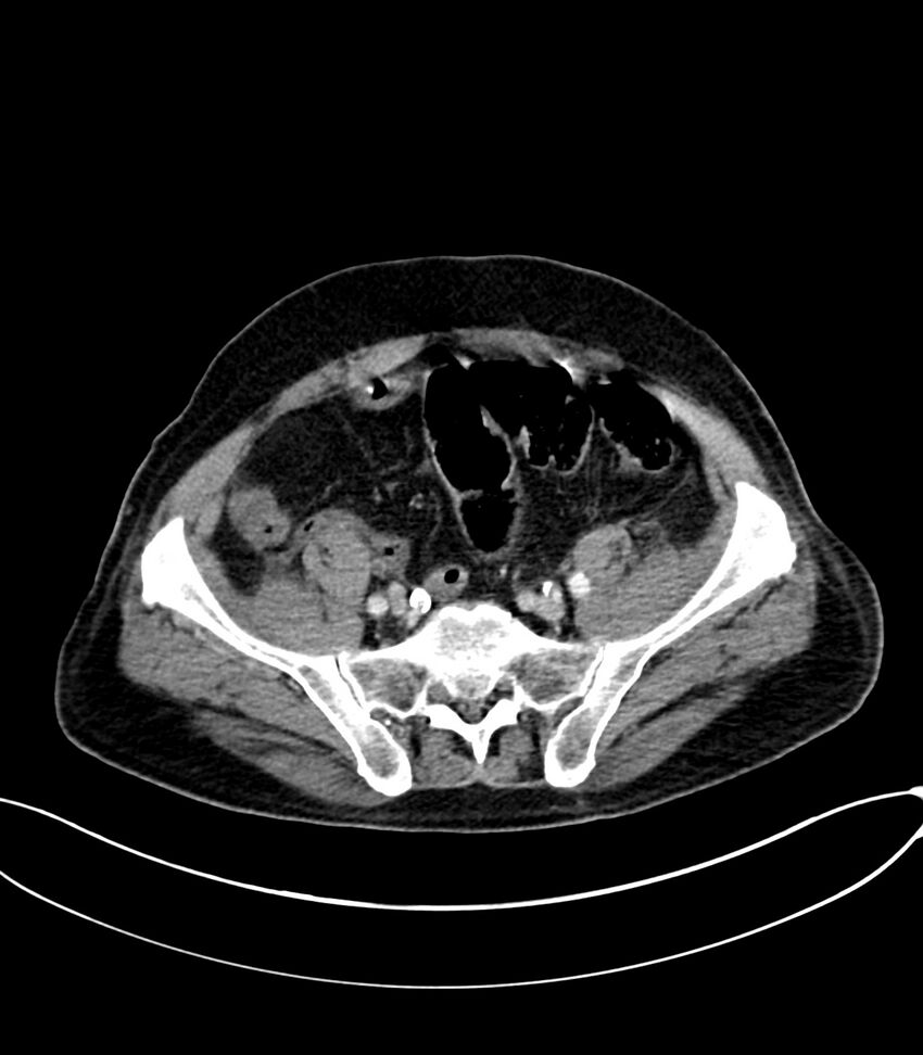 Acute arterial mesenteric ischemia (Radiopaedia 78238-90828 Axial C+ portal venous phase 108).jpg