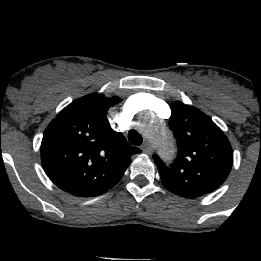 Acute chest syndrome - sickle cell disease (Radiopaedia 42375-45499 Axial C+ CTPA 49).jpg
