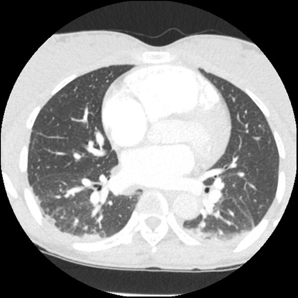 File:Acute chest syndrome - sickle cell disease (Radiopaedia 42375-45499 Axial lung window 106).jpg