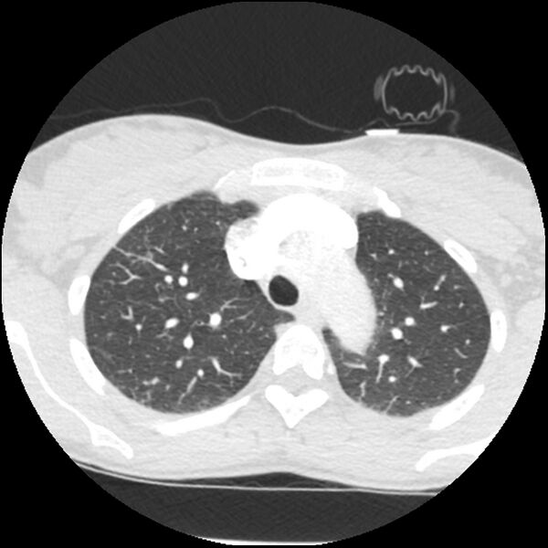 File:Acute chest syndrome - sickle cell disease (Radiopaedia 42375-45499 Axial lung window 52).jpg