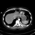 Acute myocardial infarction in CT (Radiopaedia 39947-42415 Axial C+ arterial phase 118).jpg