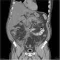 Acute pancreatitis (Radiopaedia 19135-19116 Coronal non-contrast 17).jpg