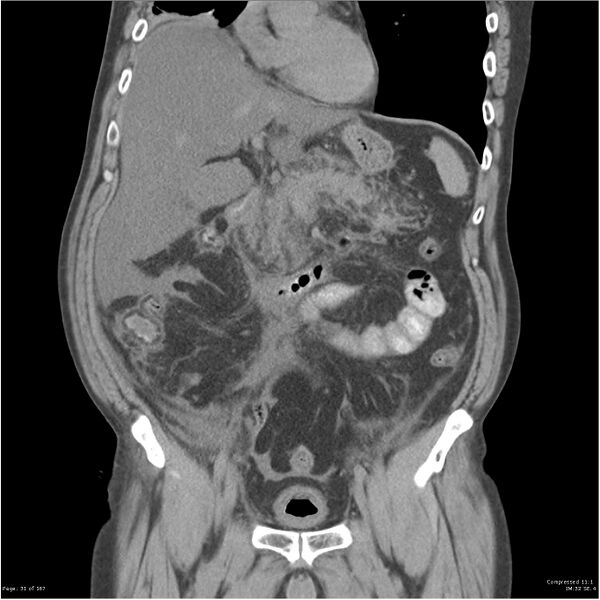 File:Acute pancreatitis (Radiopaedia 19135-19116 Coronal non-contrast 17).jpg