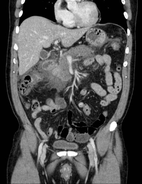 File:Acute pancreatitis - Balthazar E (Radiopaedia 23080-23110 Coronal C+ portal venous phase 30).jpg