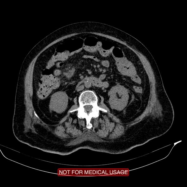 File:Acute pancreatitis with infected necrosis (Radiopaedia 26454-26585 Axial non-contrast 17).jpg