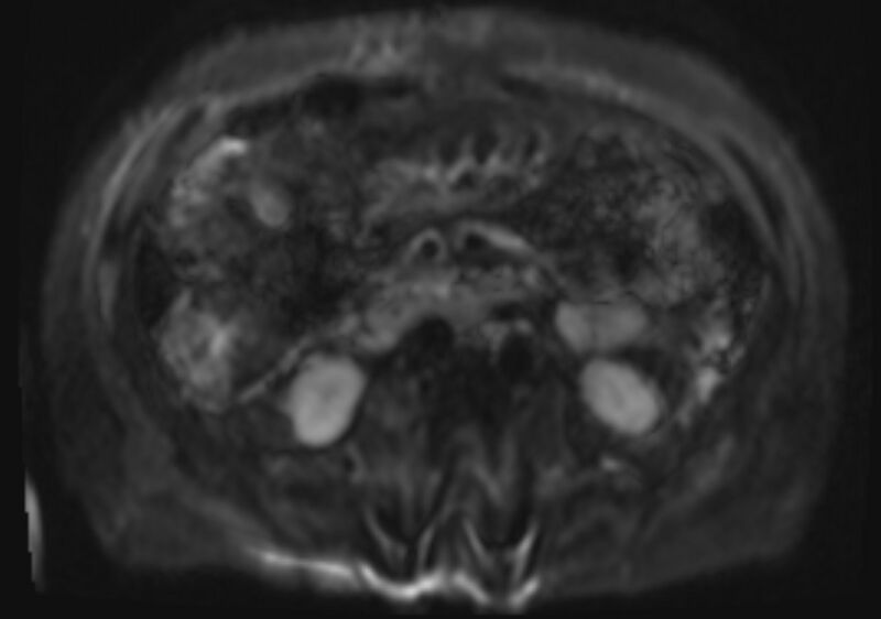 File:Acute portal vein thrombosis (Radiopaedia 73198-83925 Axial DWI 24).jpg