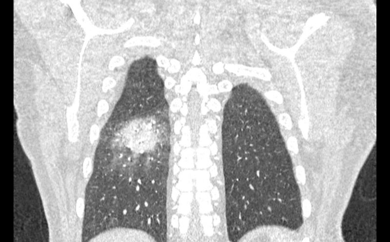 File:Acute pulmonary embolism with pulmonary infarcts (Radiopaedia 77688-89908 Coronal lung window 88).jpg