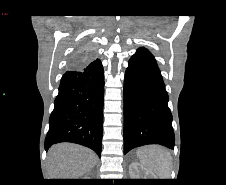 File:Acute right lung abscess (Radiopaedia 34806-36258 Coronal C+ arterial phase 10).jpg
