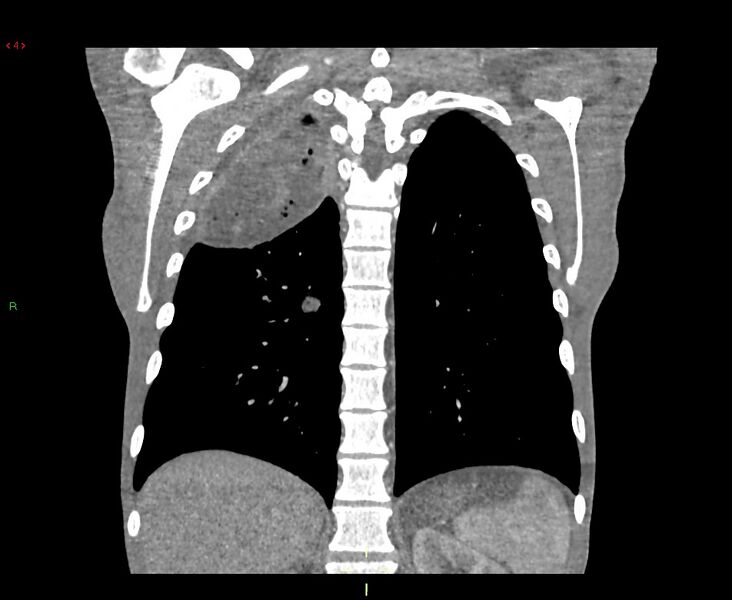 File:Acute right lung abscess (Radiopaedia 34806-36258 Coronal C+ arterial phase 14).jpg