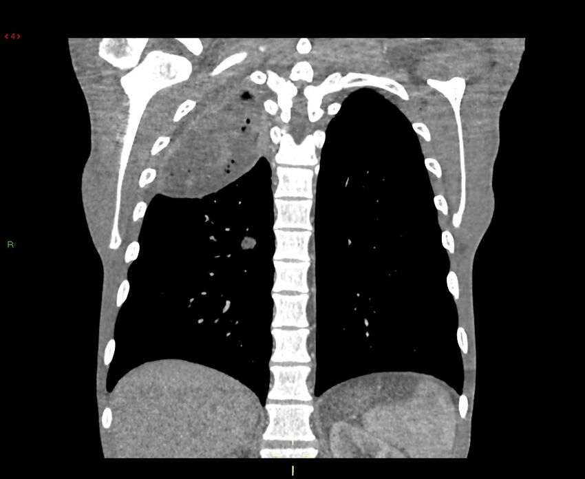 Acute right lung abscess (Radiopaedia 34806-36258 Coronal C+ arterial phase 14).jpg