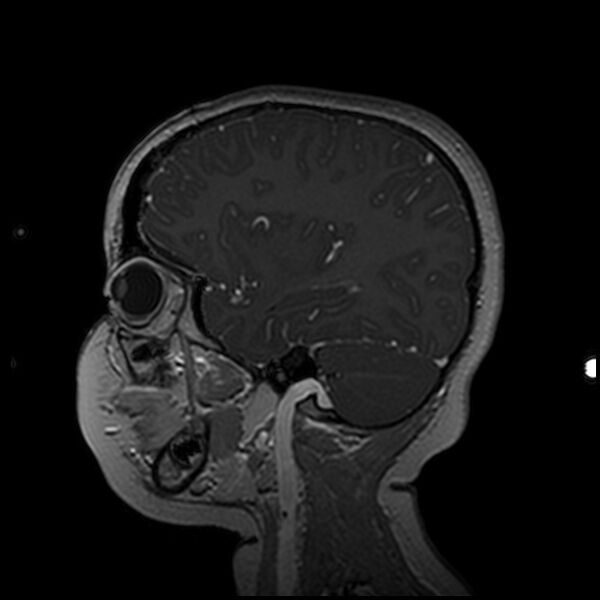 File:Adamantinomatous craniopharyngioma (Radiopaedia 77407-89529 H 87).jpg