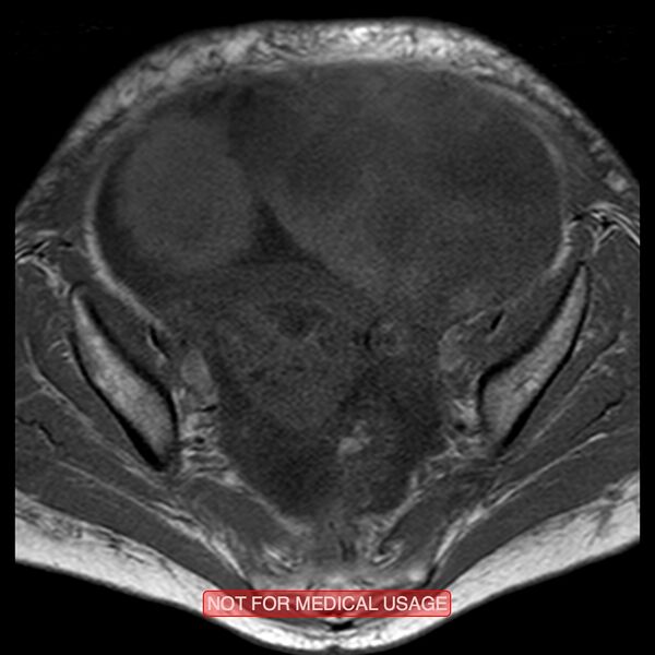 File:Adenocarcinoma of the cervix (Radiopaedia 28373-28615 Axial T1 16).jpg