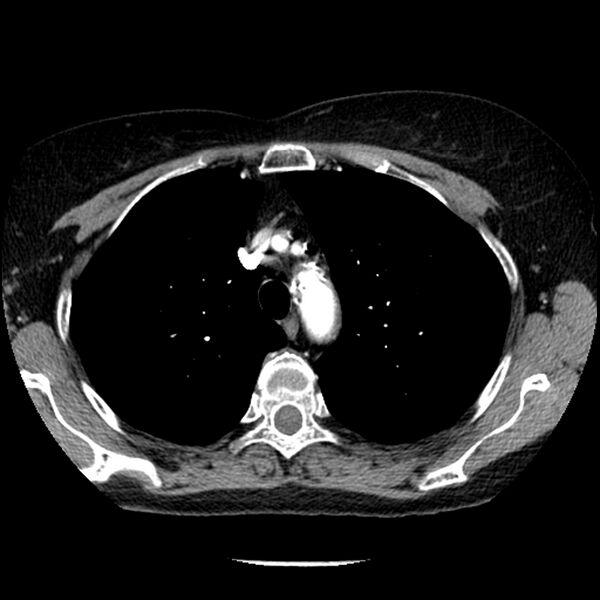 File:Adenocarcinoma of the lung (Radiopaedia 41015-43755 Axial C+ portal venous phase 31).jpg
