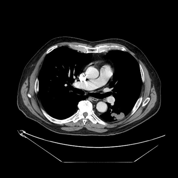 File:Adenocarcinoma of the lung (Radiopaedia 44876-48759 Axial C+ portal venous phase 40).jpg