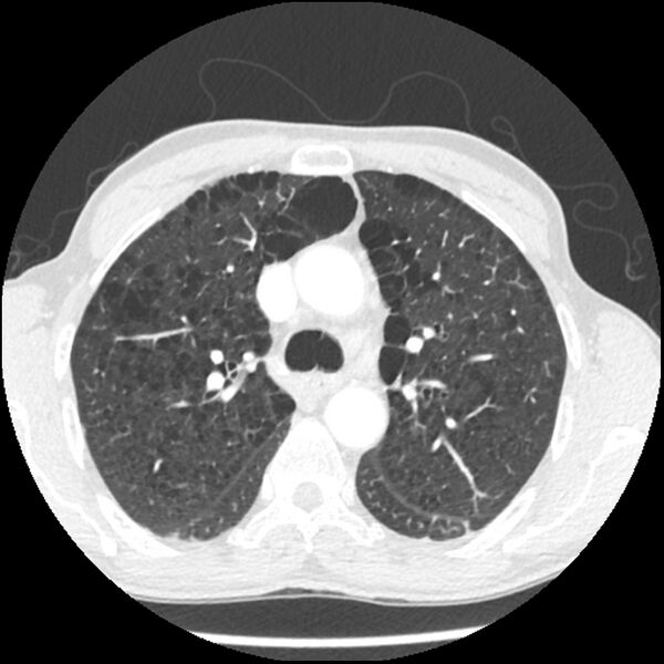 File:Adenocarcinoma of the lung - micropapillary predominant (Radiopaedia 42446-45563 C 6).jpg