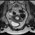 Adenoma malignum of the cervix (Radiopaedia 24460-24765 Coronal T2 9).jpg