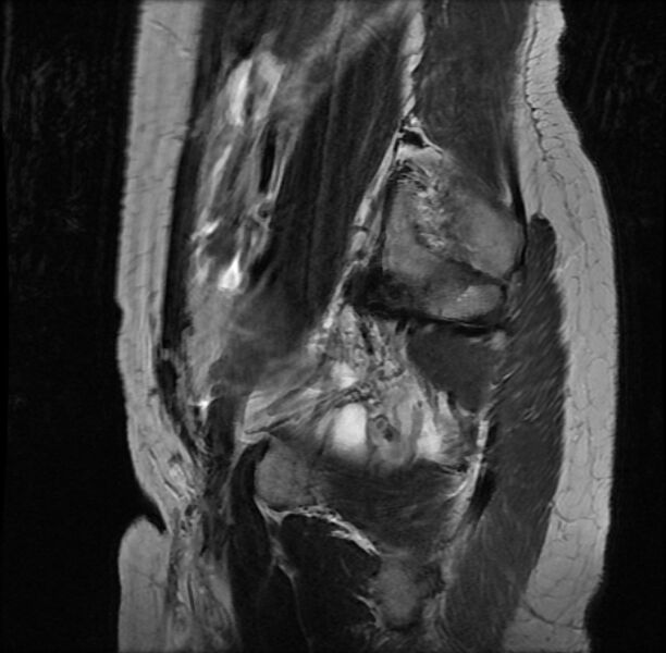 File:Adenomyosis on MRI (Radiopaedia 29328-29780 Sagittal T2 1).jpg