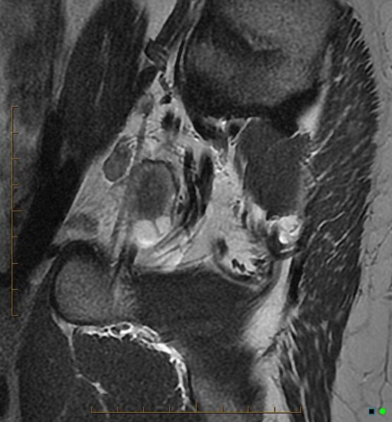 File:Adenomyosis uterus with hematometra (Radiopaedia 45779-50011 Sagittal T2 2).jpg