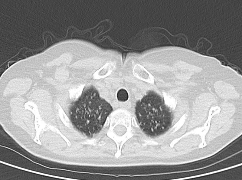 File:Adenosquamous lung carcinoma (Radiopaedia 22035-22030 lung window 15).jpg