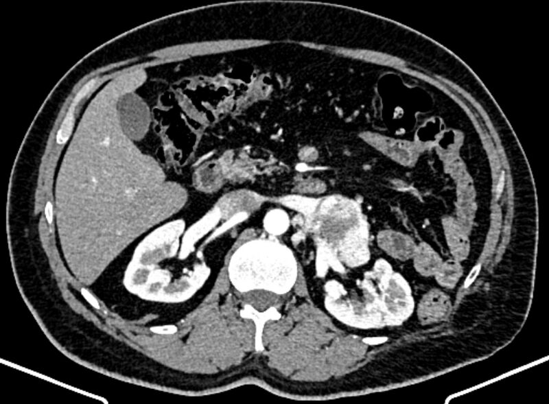 File:Adrenal metastases (Radiopaedia 73082-83791 Axial C+ arterial phase 68).jpg