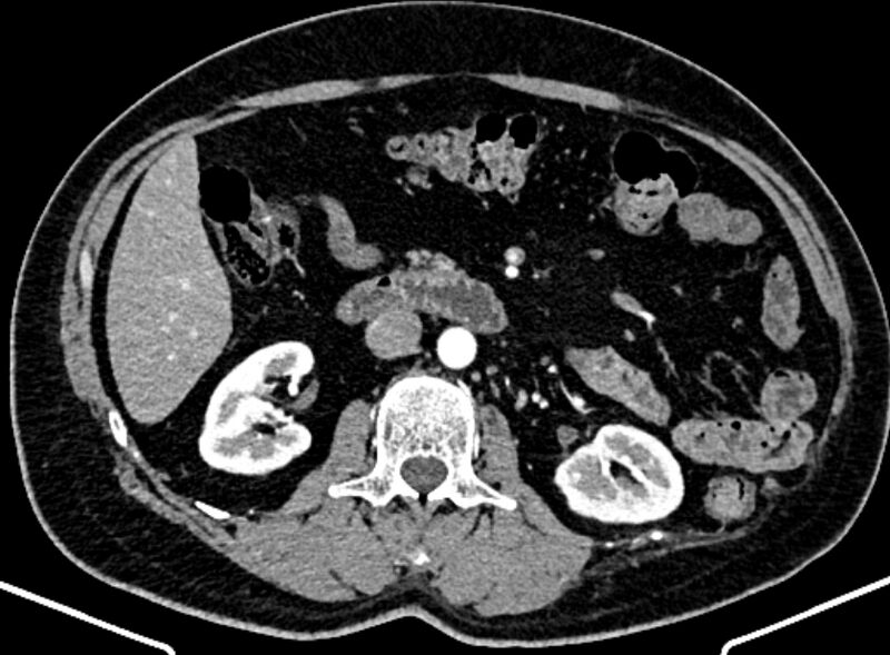 File:Adrenal metastases (Radiopaedia 73082-83791 Axial C+ arterial phase 80).jpg
