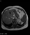 Adrenal myelolipoma (Radiopaedia 6765-7961 Axial T1 out-of-phase 11).jpg