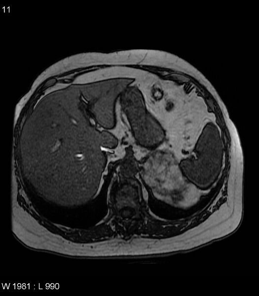 File:Adrenal myelolipoma (Radiopaedia 6765-7961 Axial T1 out-of-phase 11).jpg