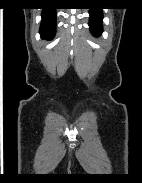 File:Adrenal myelolipoma - bilateral (Radiopaedia 74805-85810 Coronal C+ portal venous phase 56).jpg