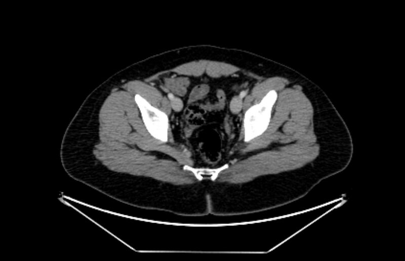 File:Adrenocortical carcinoma (Radiopaedia 80134-93438 Axial C+ portal venous phase 117).jpg