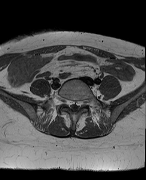File:Adult granulosa cell tumor of the ovary (Radiopaedia 71581-81950 Axial T1 4).jpg