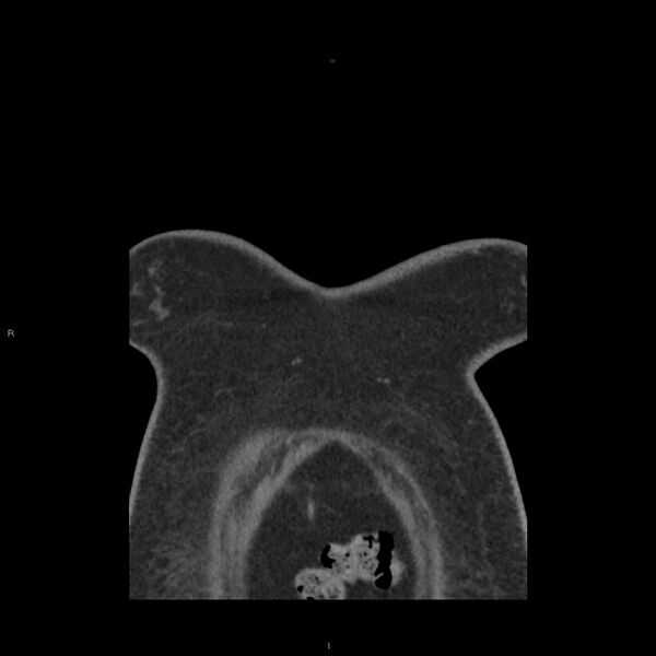 File:Agenesis of the left hepatic lobe (Radiopaedia 77284-89359 Coronal C+ CTPA 82).jpg