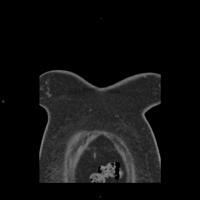 Agenesis of the left hepatic lobe (Radiopaedia 77284-89359 Coronal C+ CTPA 82).jpg