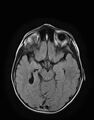 Aicardi syndrome (Radiopaedia 66029-75205 Axial FLAIR 11).jpg