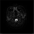 Amnestic syndrome secondary to hypoxic brain injury (Radiopaedia 24743-25004 DWI 33).jpg