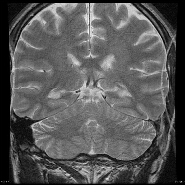File:Amnestic syndrome secondary to hypoxic brain injury (Radiopaedia 24743-25004 F 3).jpg