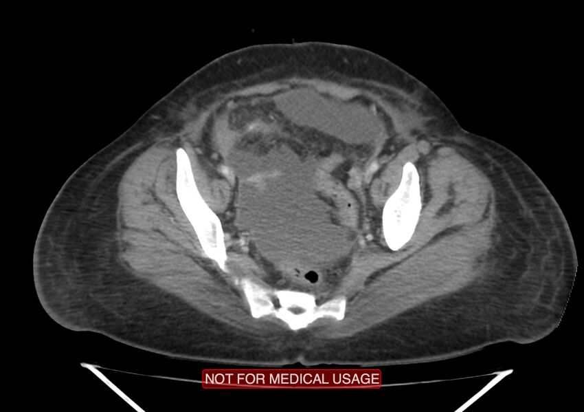 Amoebic enterocolitis with liver abscess (Radiopaedia 35100-36609 A 70).jpg