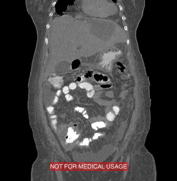 File:Amoebic enterocolitis with liver abscess (Radiopaedia 35100-36609 B 44).jpg