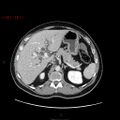 Ampullary carcinoma (Radiopaedia 56396-63056 C 28).jpg