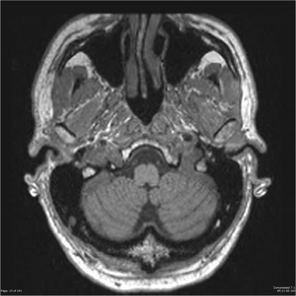 File:Anaplastic meningioma with recurrence (Radiopaedia 34452-35788 Axial T1 11).jpg