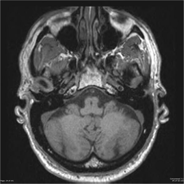 File:Anaplastic meningioma with recurrence (Radiopaedia 34452-35788 Axial T1 22).jpg