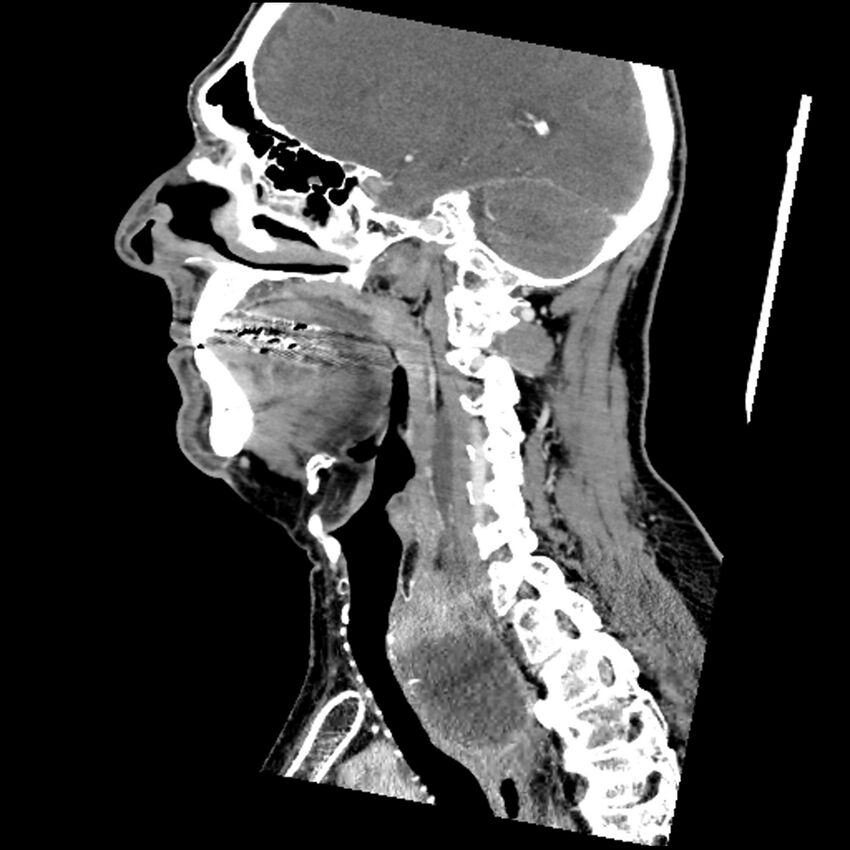 Anaplastic thyroid carcinoma (Radiopaedia 79087-92034 C 55).jpg