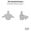 Anderson and D'Alonzo classification of C2 odontoid fractures (diagrams) (Radiopaedia 87249-103528 type 1 1).jpeg