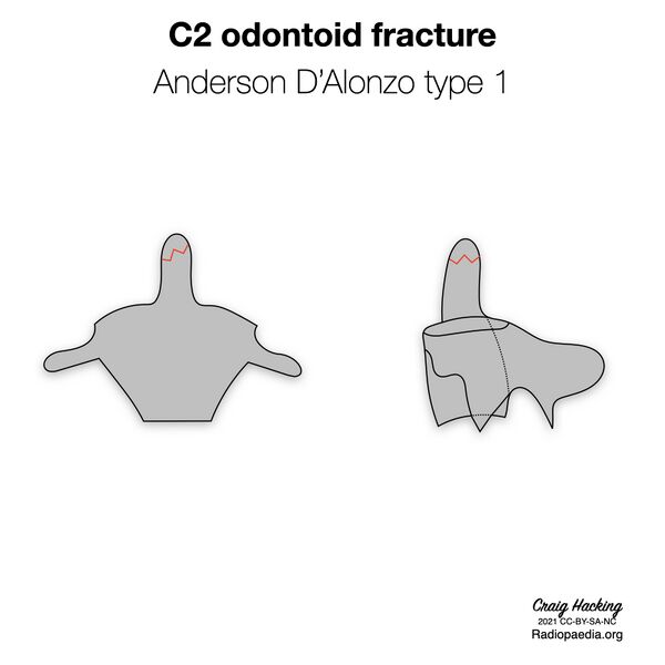 File:Anderson and D'Alonzo classification of C2 odontoid fractures (diagrams) (Radiopaedia 87249-103528 type 1 1).jpeg