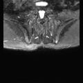 Ankylosing spondylitis with zygapophyseal arthritis (Radiopaedia 38433-40517 D 18).jpg