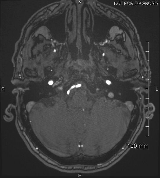 File:Anterior cerebral artery aneurysm (Radiopaedia 80683-94127 Axial MRA 42).jpg