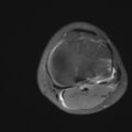 Anterior cruciate ligament tear - pediatric (Radiopaedia 62152-70260 Axial PD fat sat 28).jpg