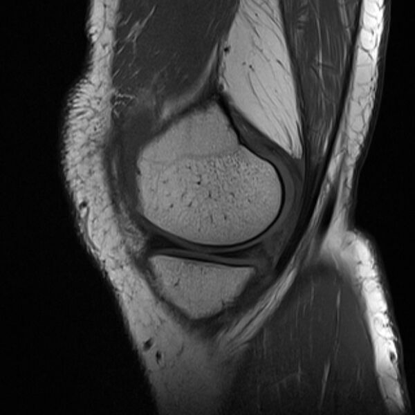 File:Anterior cruciate ligament tear - ramp lesion (Radiopaedia 71883-82322 Sagittal T1 20).jpg