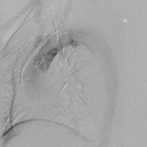 File:Aortic arch false aneurysm (Radiopaedia 14667-14589 Final result 7).jpg