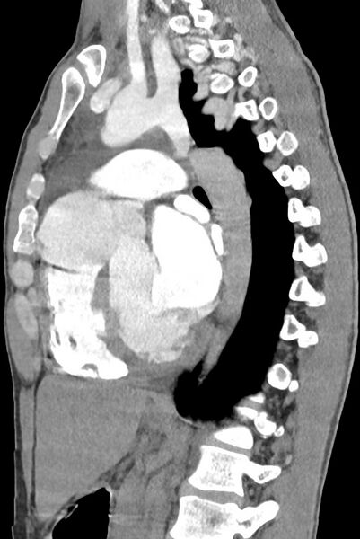 File:Aortic coarctation with aneurysm (Radiopaedia 74818-85828 B 93).jpg